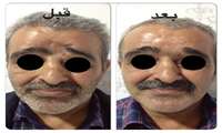 جراح فک و صورت بیمارستان 22آبان به مشکل فرو رفتگی پیشانی یک مرد پایان داد