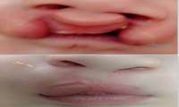 ترمیم شکاف کام و لب نوزاد 3ماهه