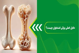 بخوانید | پوکی استخوان در یک نگاه